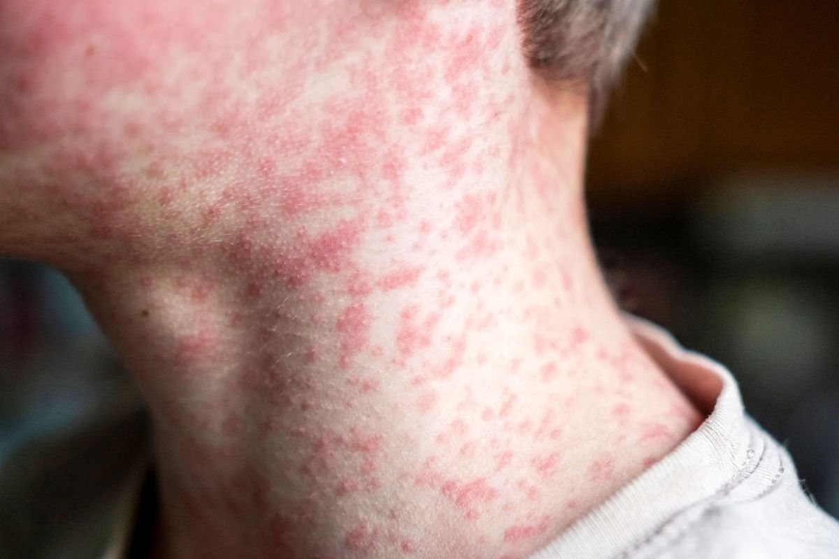 Reportan 10 nuevos casos de sarampión en Puebla