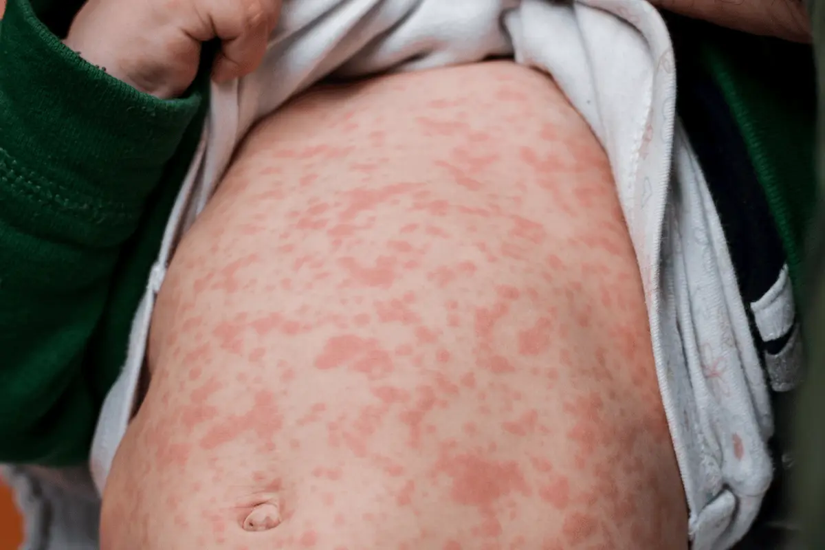 Sarampión en Puebla