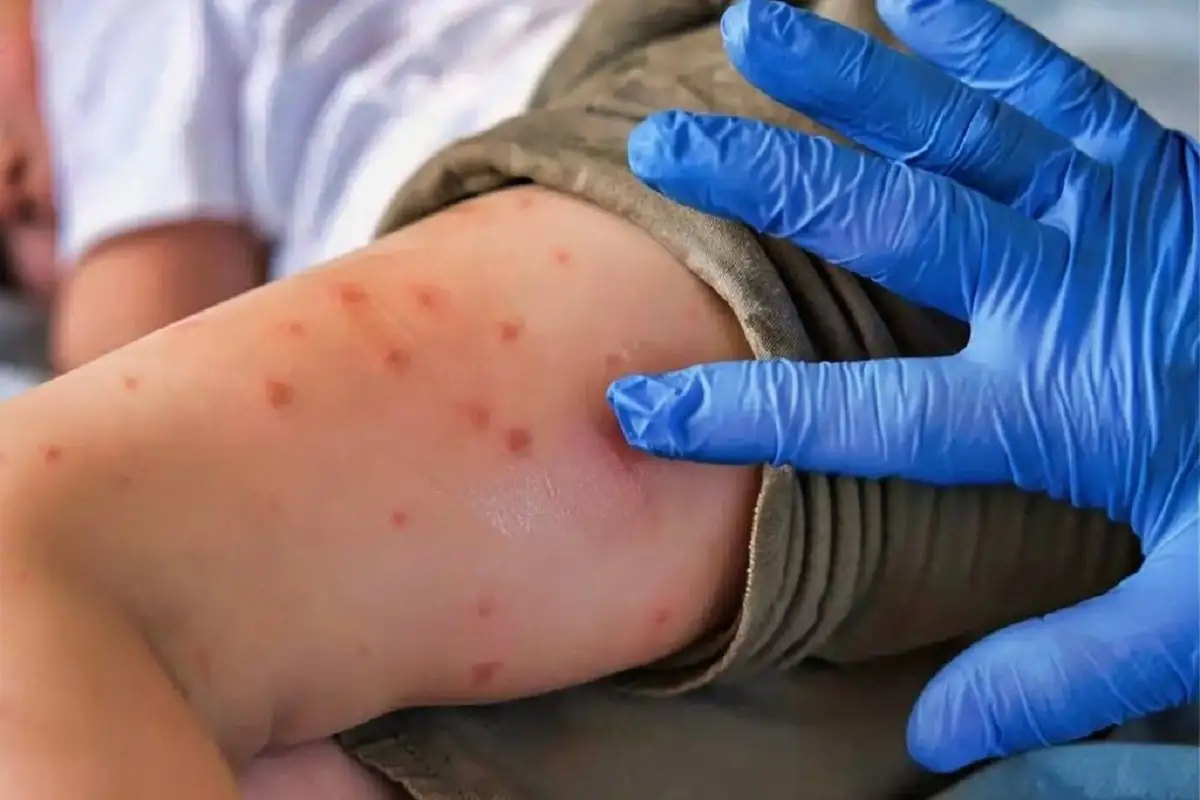 Detectan brote de sarampión en el Mercado Hidalgo