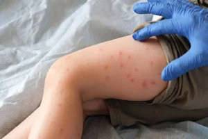 Así van los casos confirmados de sarampión en Puebla