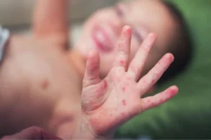 Ya van 44 casos confirmados de sarampión en Puebla