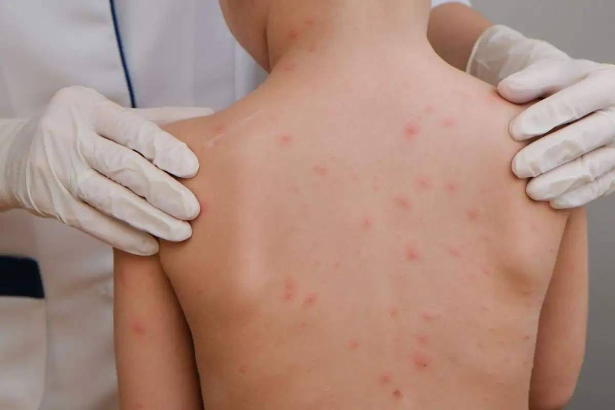 Suman más de 9 mil casos de sarampión en México desde 2025