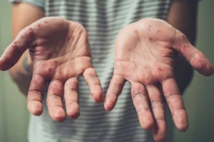 En 4 días, incrementan casos de sarampión en Puebla; van 66