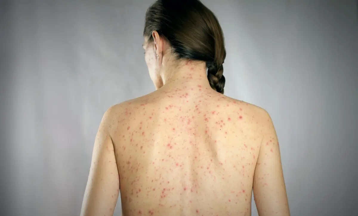 Sarampión en adultos